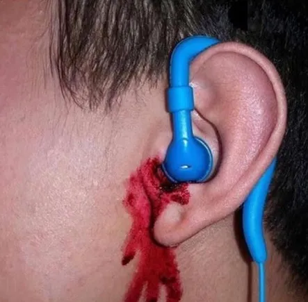 Ear bleed 