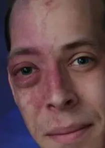 Pink eye kike style 
