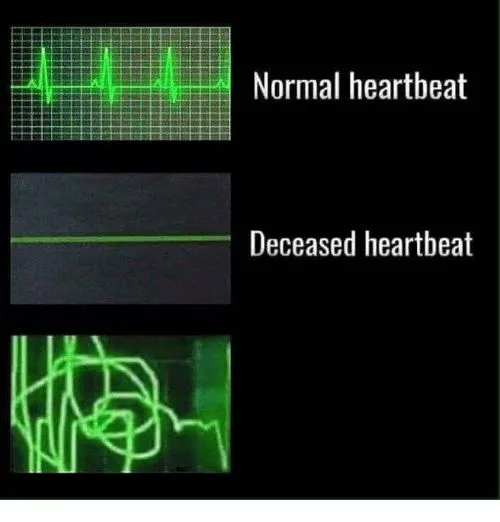 normal heartbeat deceased heartbeat 