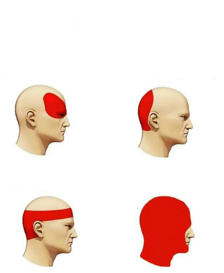 types of headache 